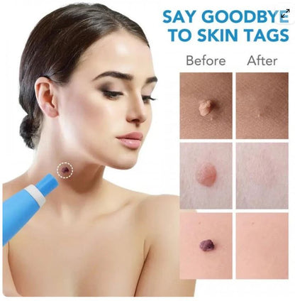 Skin Tag Remover Kit